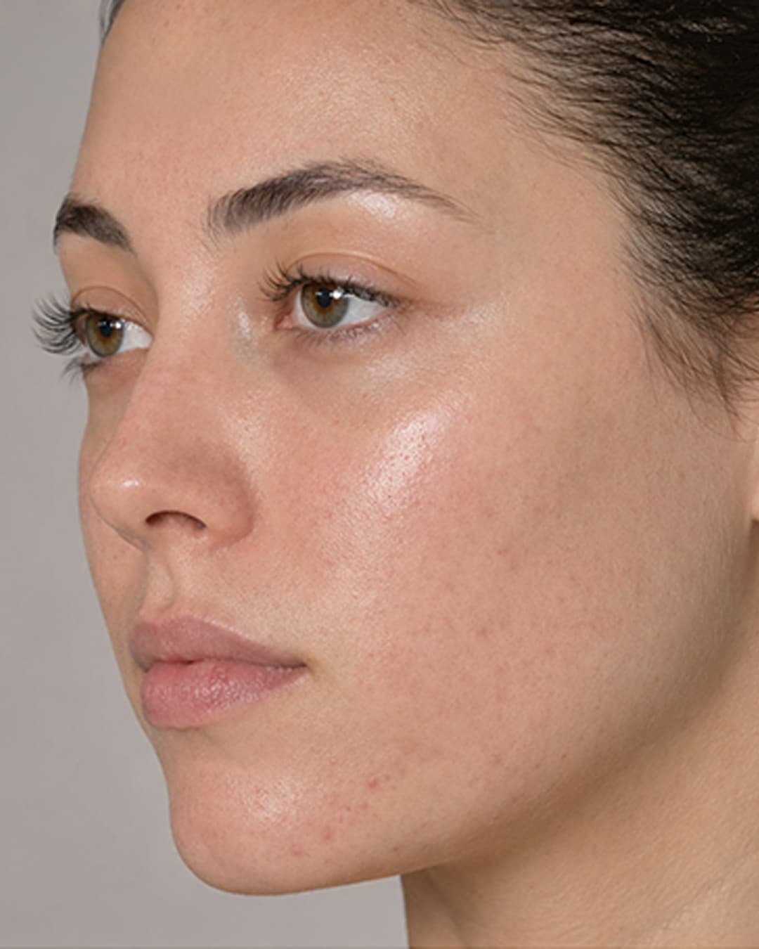 Skin progress at WK 03
